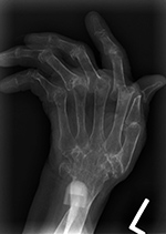Ulnar head prosthesis